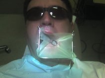 Root Canal