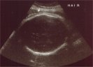 Baby hair seen during an ultrasound at 35w2d