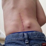 Caden Scoliosis VETR Rods