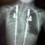 Caden's x-ray from July 2011